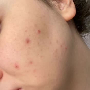 Bioderma Atoderm Cream Ultra’da Yüzde Şiddetli Komedon Ve Sivilcelenme