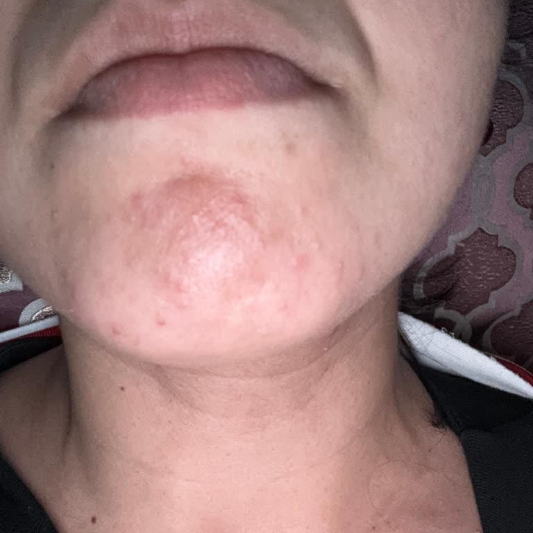 Dermoskin Yüz Yıkama Ürünü Kullanımından Şiddetli Cilt Reaksiyonu