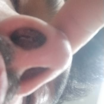 Turgut Özal Tıp Merkezi Rinoplasti Sonrası Hastane Kaynaklı Klebsiella Enfeksiyonu