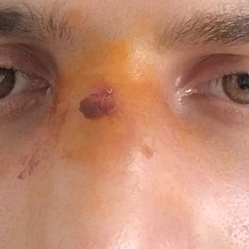 Turgut Özal Tıp Merkezi Rinoplasti Sonrası Hastane Kaynaklı Klebsiella Enfeksiyonu