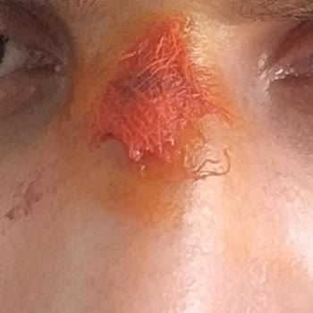 Turgut Özal Tıp Merkezi Rinoplasti Sonrası Hastane Kaynaklı Klebsiella Enfeksiyonu