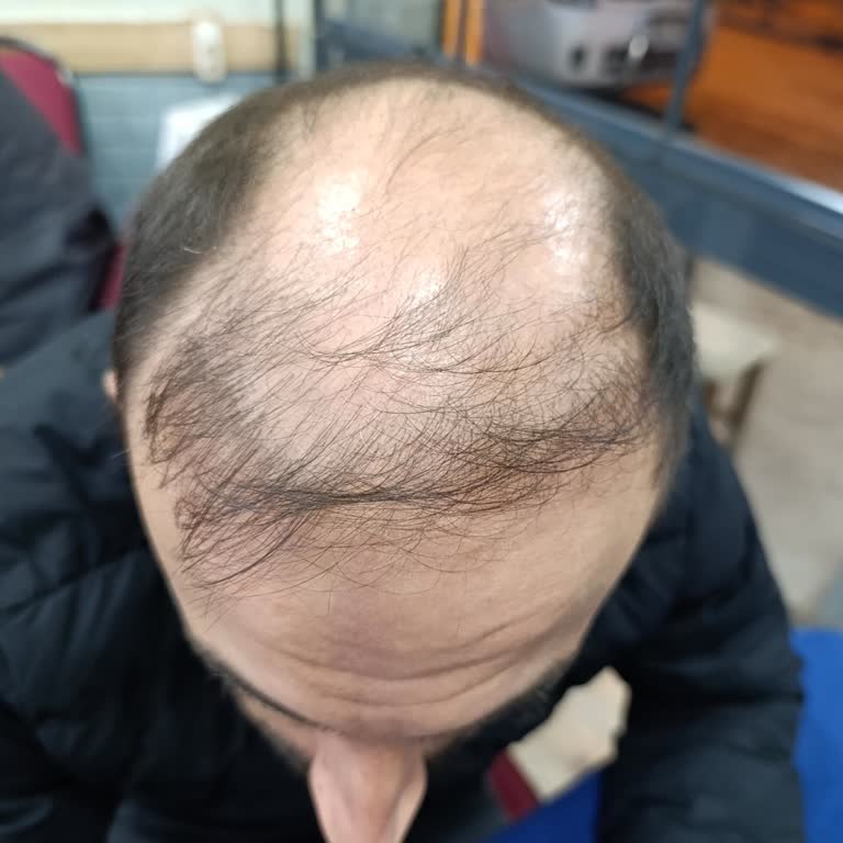 Stajyer Ekibi Tarafından Yapılan Saç Ekimi Başarısız, 25.000 TL İadesi Talebi