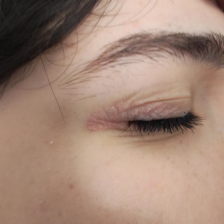 Bee Beauty Micellar Suyu Göz Kapağında Şiddetli Tahrişe Yol Açtı