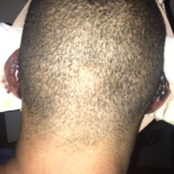 Medical Park Hastanesi’nde Kulak Ameliyatı Sonrası Şişlik Ve Ağrı Nedeniyle Malpraktis İddiası