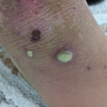 Mustela Stelatopia Kullanımından Sonra Ciltte Şiddetli İltihap Ve Apse Oluştu