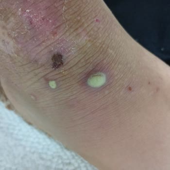 Mustela Stelatopia Kullanımından Sonra Ciltte Şiddetli İltihap Ve Apse Oluştu