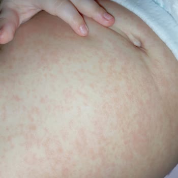 Aptamil Prosyneo Formülünün Kullanımı Sonrası Bebeğimde Şiddetli Cilt Kabarıkları Ve Mağduriyet