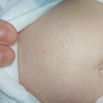 Aptamil Prosyneo Formülünün Kullanımı Sonrası Bebeğimde Şiddetli Cilt Kabarıkları Ve Mağduriyet