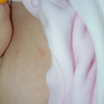 Aptamil Prosyneo Formülünün Kullanımı Sonrası Bebeğimde Şiddetli Cilt Kabarıkları Ve Mağduriyet