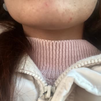 Kars Deluxe Vip Güzellik Merkezinde Zararlı Cilt Bakımı Ve Ücret İptali