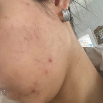 Kars Deluxe Vip Güzellik Merkezinde Zararlı Cilt Bakımı Ve Ücret İptali