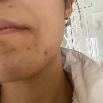 Kars Deluxe Vip Güzellik Merkezinde Zararlı Cilt Bakımı Ve Ücret İptali