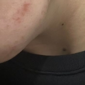 Tam Vücut Epilasyonda Yanık, İade Talebi Reddi