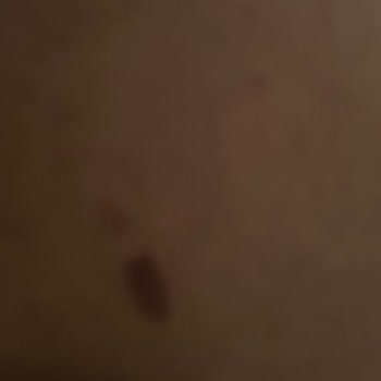 Tam Vücut Epilasyonda Yanık, İade Talebi Reddi