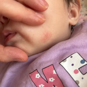 Bebek Cildinde Mustela Kremi Sonrası Alerjik Reaksiyon