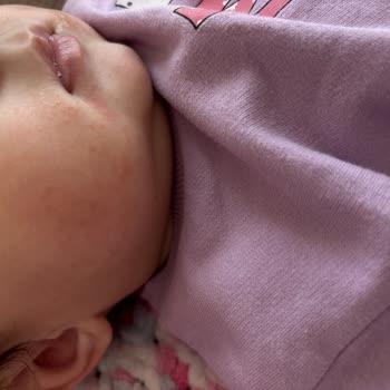 Bebek Cildinde Mustela Kremi Sonrası Alerjik Reaksiyon