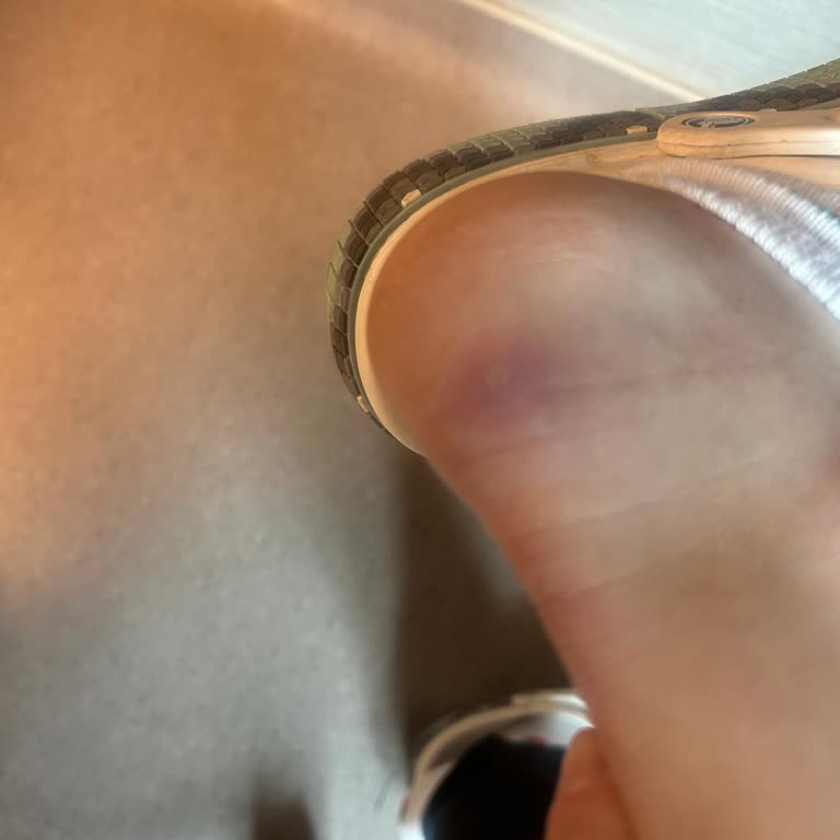 Sağ Topuğumda Yanma Ve Kanama Yaratan Boyner Botu Ve 21 Günlük Bilgilendirme Eksikliği