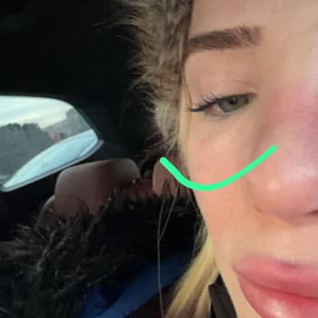 Vita Estetik'te Yanlış Göz Altı Liposakşın İşlemi Ve Ücret İadesinin Reddedilmesi