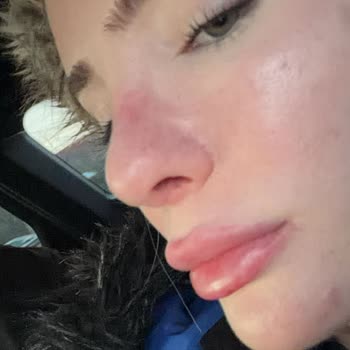 Vita Estetik'te Yanlış Göz Altı Liposakşın İşlemi Ve Ücret İadesinin Reddedilmesi