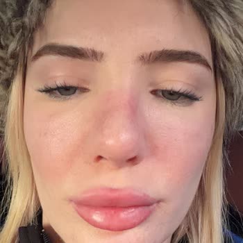 Vita Estetik'te Yanlış Göz Altı Liposakşın İşlemi Ve Ücret İadesinin Reddedilmesi