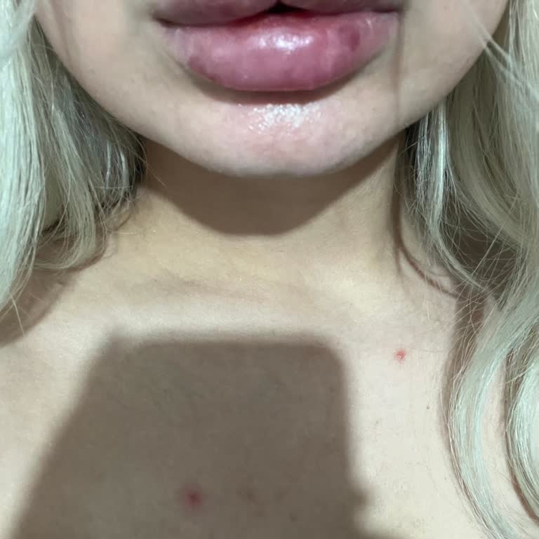 Venedik Clinic Hyaluronidaz Stokta Olmadığı İçin Dolgu Düzeltme Sürecindeki Klinik İhmali