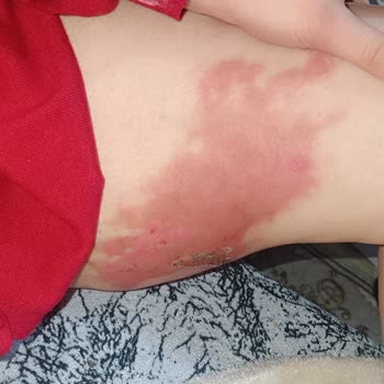 Karadeniz Ereğli Devlet Hastanesi Acil Servis Gecikmesi Ve Kalıcı Yanık İzleri