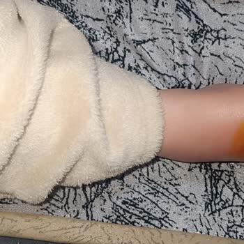 Karadeniz Ereğli Devlet Hastanesi Acil Servis Gecikmesi Ve Kalıcı Yanık İzleri