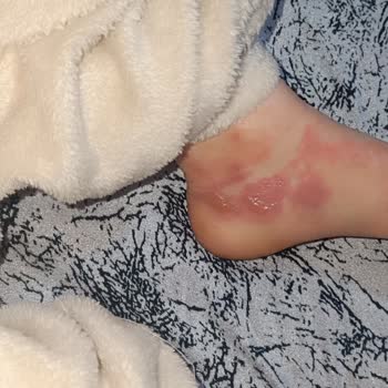 Karadeniz Ereğli Devlet Hastanesi Acil Servis Gecikmesi Ve Kalıcı Yanık İzleri