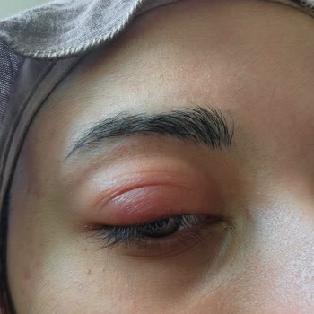 Maskara Kullanımı Sonrası Göz Enfeksiyonu Ve Flormar'dan Yanıtsızlık