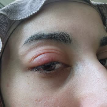 Maskara Kullanımı Sonrası Göz Enfeksiyonu Ve Flormar'dan Yanıtsızlık