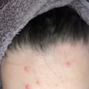 Pure Beauty BB Krem Yüzümde Şiddetli Sivilcelere Neden Oldu Sağlık Endişesi Yaratıyor