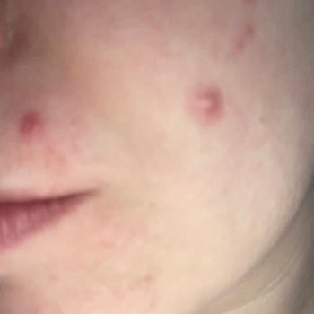 Pure Beauty BB Krem Yüzümde Şiddetli Sivilcelere Neden Oldu Sağlık Endişesi Yaratıyor