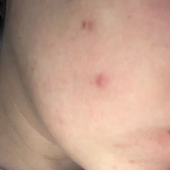 Pure Beauty BB Krem Yüzümde Şiddetli Sivilcelere Neden Oldu Sağlık Endişesi Yaratıyor