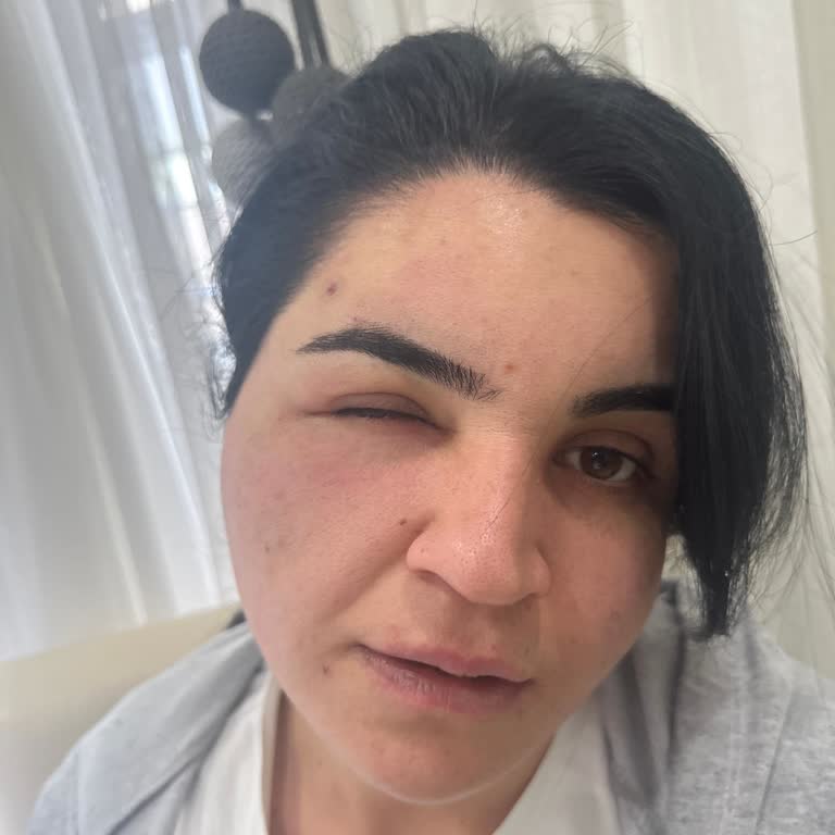 Saç Boyasında Tarih Hatası Nedeniyle Şiddetli Alerjik Reaksiyon