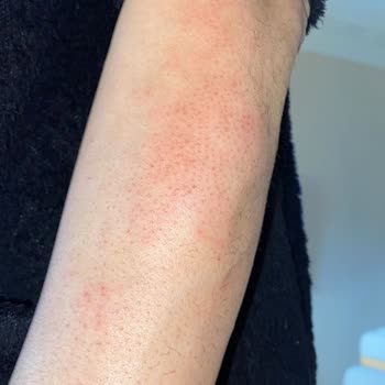 Lure Sir Ağda Geçmeyen Bir Yanma Ve Acı Hissi Devam Ediyor