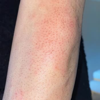 Lure Sir Ağda Geçmeyen Bir Yanma Ve Acı Hissi Devam Ediyor