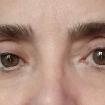 Maya Estetik Etiler'de 3500 Euro'luk Sol Göz Kapağı Düşüklüğü