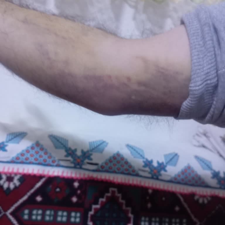 Eskişehir Şehir Hastanesi Kan Alımında Şiddetli Morarma Ve Ağrı Nedeniyle Sorumluluk Talebi