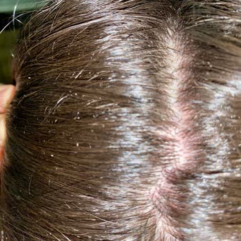 Saç Dökülmesi Karşıtı Şampuanın Yanma Ve Kaşınma Sorunu Eczane İnceleme Gecikmesi