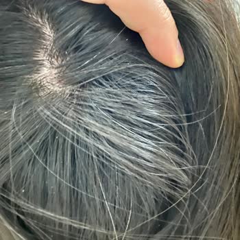 Saç Dökülmesi Karşıtı Şampuanın Yanma Ve Kaşınma Sorunu Eczane İnceleme Gecikmesi