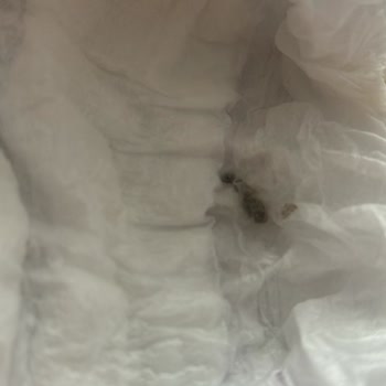 Molfix Bebek Bezinde Yabancı Madde Tespiti Ve Sağlık Endişesi