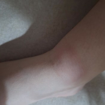 Çocuğumun Ayağında Şişme Oluştuğu İçin Hummel Ayakkabı Değişimi Talebi