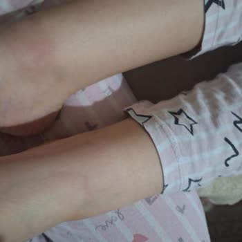 Çocuğumun Ayağında Şişme Oluştuğu İçin Hummel Ayakkabı Değişimi Talebi