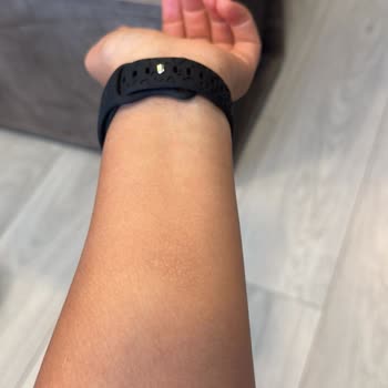 Lazer Epilasyon Sonuç Vermedi, Yanıklar Ve Sonrası İlgi Eksikliği