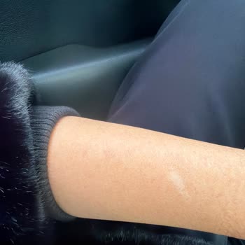 Lazer Epilasyon Sonuç Vermedi, Yanıklar Ve Sonrası İlgi Eksikliği