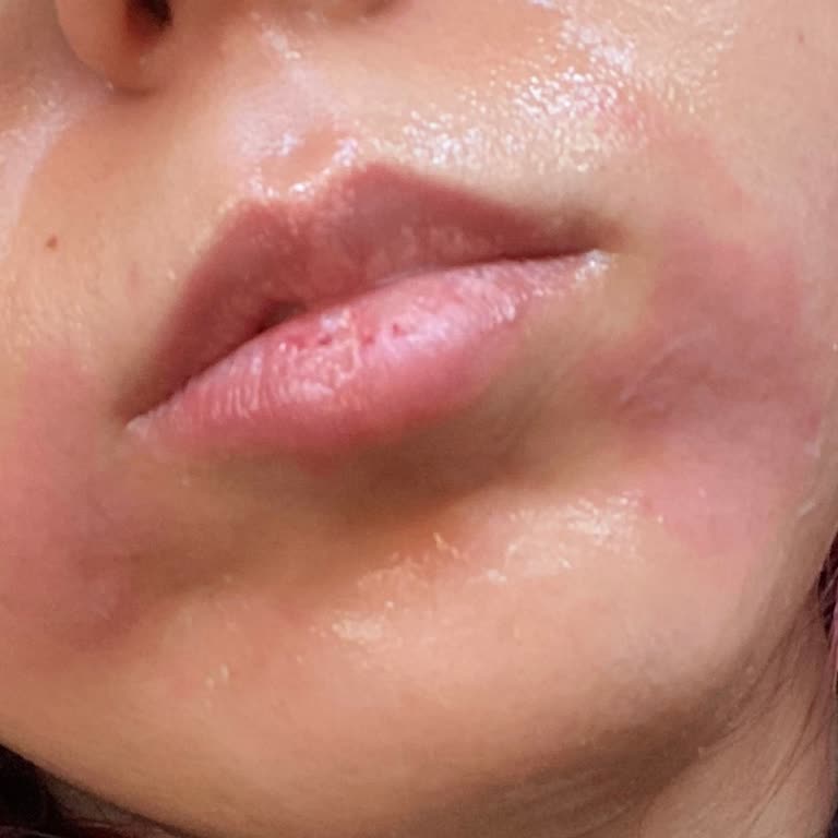 Tara Kuaför'de Ağıda İşleminde Şiddetli Yanık Ve Umursamaz Tavır Nedeniyle Ücret İadesi Talebi