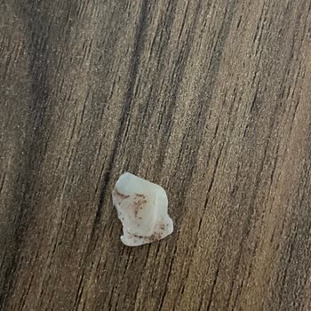 Tokat Ağız Ve Diş Hastanesi’nde Hatalı Dolgu Sonrası Diş Kırılması