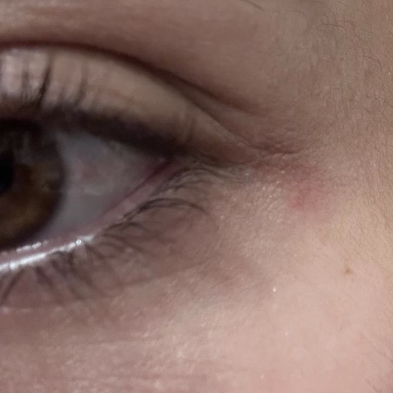 Gözlerimde Kızarıklık Ve Şişme Yaratan Ürün İçin İade Reddi