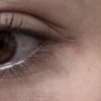 Göz Makyaj Temizleyicisinin Sağlık Sorunu Sonrası İade Talebimin Reddedilmesi