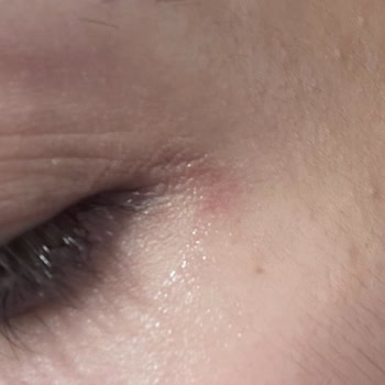 Göz Makyaj Temizleyicisinin Sağlık Sorunu Sonrası İade Talebimin Reddedilmesi